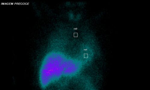 Neuroimagem molecular e o parkinsonismo pós SARS-COV2