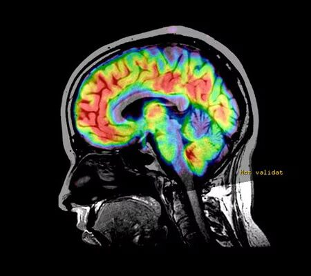 Técnicas e Pós-processamento em Neuroimagem por RM